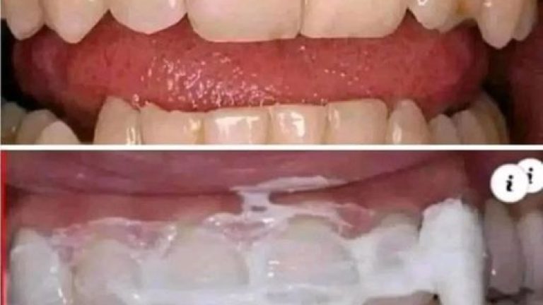 No Importa Cuántas Caries Tengas Elimínalas Desde Casa Fácilmente
