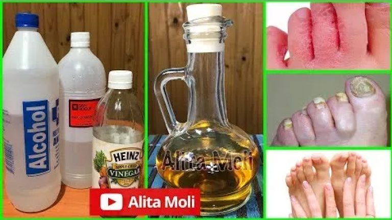 ELIMINA LOS HONGOS DE TUS UÑAS Y PIES DEFINITIVAMENTE CON ESTE REMEDIO NATURAL