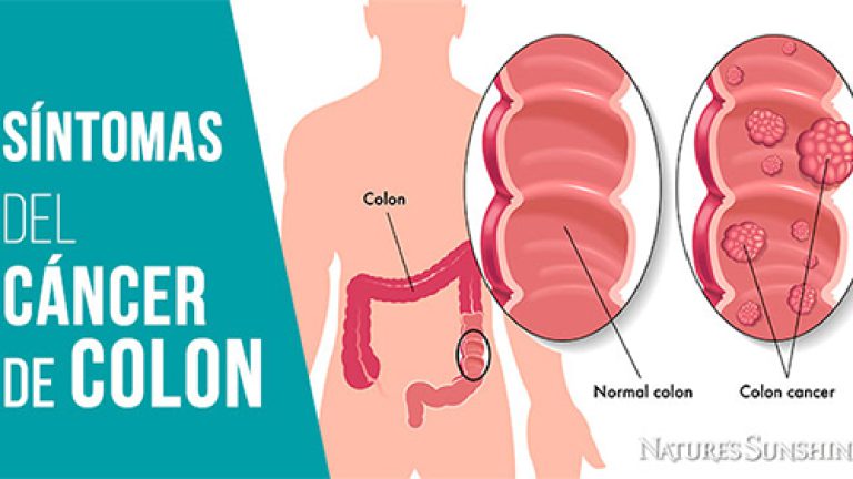 Mantente alerta! Estos son los síntomas del cáncer de colon