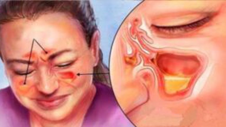 Ayuda con la congestión nasal en solo 1 minuto y saca el moco acumulado y la flema.