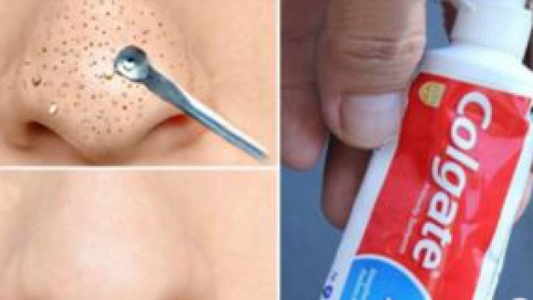 Tratamiento eficaz para las espinillas y puntos negros en la nariz y el rostro.